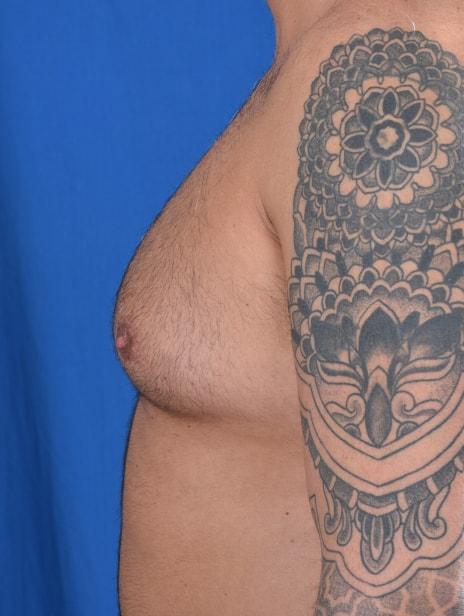 Gynecomastia Surgery before at Millard Plastic Surgery in Englewood, CO