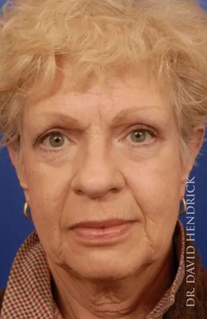 Blepharoplasty after at Millard Plastic Surgery in Englewood, CO