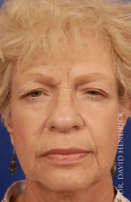 Blepharoplasty before at Millard Plastic Surgery in Englewood, CO