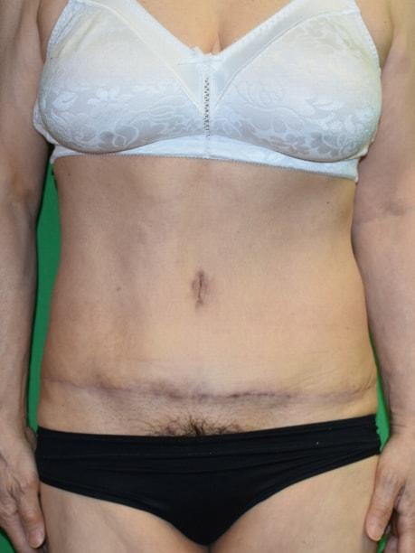 Mini Tummy Tuck after at Millard Plastic Surgery in Englewood, CO