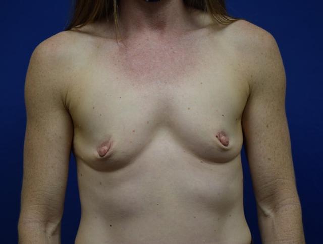 Breast Augmentation before at Millard Plastic Surgery in Englewood, CO
