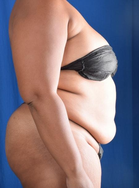 Liposuction before at Millard Plastic Surgery in Englewood, CO
