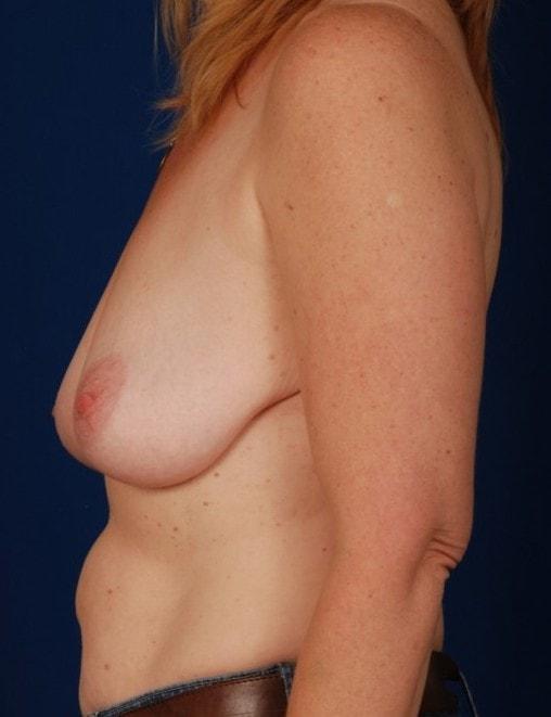 Breast Lift before at Millard Plastic Surgery in Englewood, CO