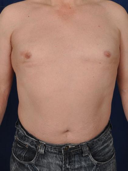 Gynecomastia Surgery after at Millard Plastic Surgery in Englewood, CO