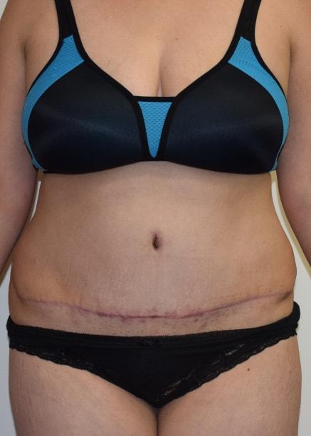 Mini Tummy Tuck after at Millard Plastic Surgery in Englewood, CO