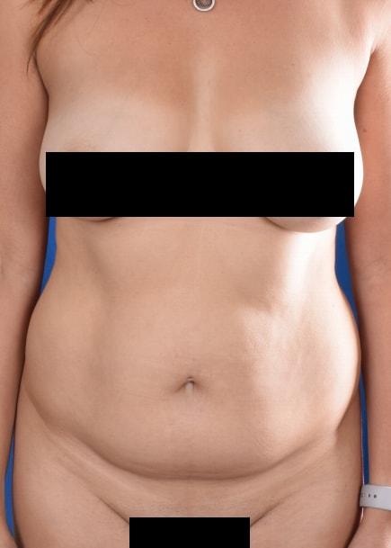 Mini Tummy Tuck before at Millard Plastic Surgery in Englewood, CO