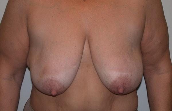 Breast Lift before at Millard Plastic Surgery in Englewood, CO