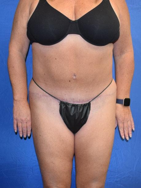 Millard Plastic Surgery tummy tuck after — Englewood, CO