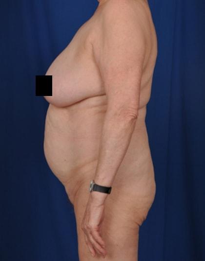 Liposuction before at Millard Plastic Surgery in Englewood, CO