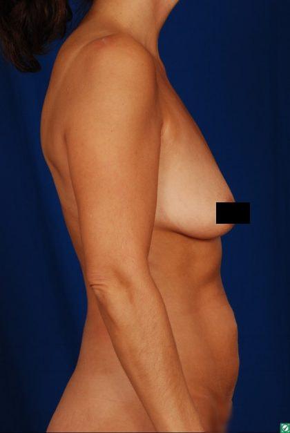 Mommy Makeover before at Millard Plastic Surgery in Englewood, CO