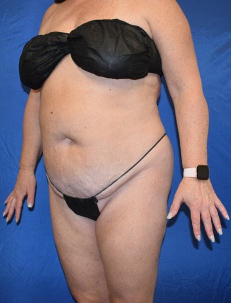 Mini Tummy Tuck before at Millard Plastic Surgery in Englewood, CO