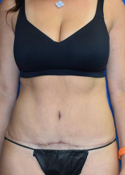 Mini Tummy Tuck after at Millard Plastic Surgery in Englewood, CO