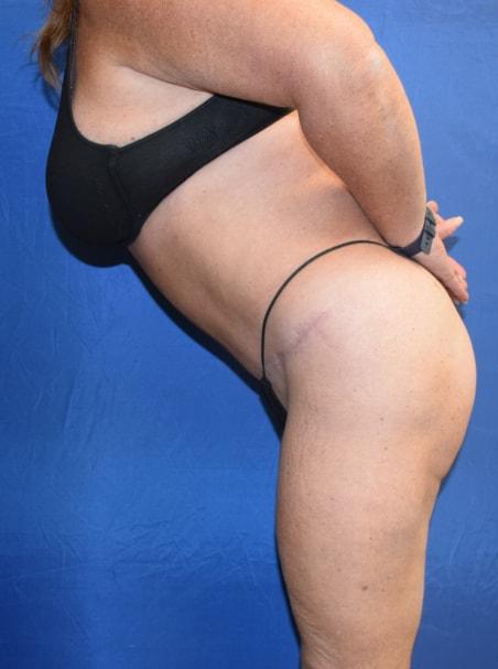 Millard Plastic Surgery tummy tuck after — Englewood, CO