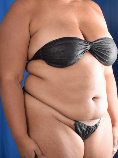 Liposuction before at Millard Plastic Surgery in Englewood, CO