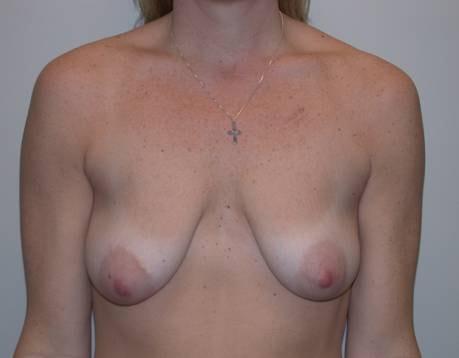 Breast Lift before at Millard Plastic Surgery in Englewood, CO