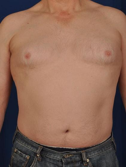 Gynecomastia Surgery before at Millard Plastic Surgery in Englewood, CO