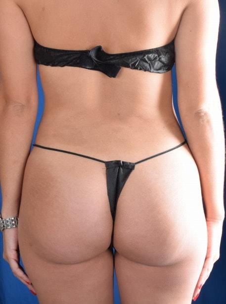 Millard Plastic Surgery bbl after — Englewood, CO