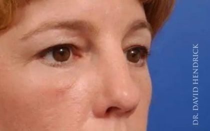 Millard Plastic Surgery after — Englewood, CO