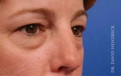 Blepharoplasty before at Millard Plastic Surgery in Englewood, CO