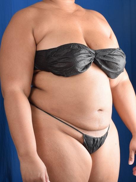 Liposuction after at Millard Plastic Surgery in Englewood, CO