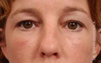 Blepharoplasty after at Millard Plastic Surgery in Englewood, CO