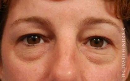 Blepharoplasty before at Millard Plastic Surgery in Englewood, CO