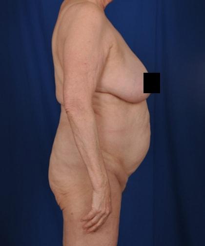 Liposuction before at Millard Plastic Surgery in Englewood, CO
