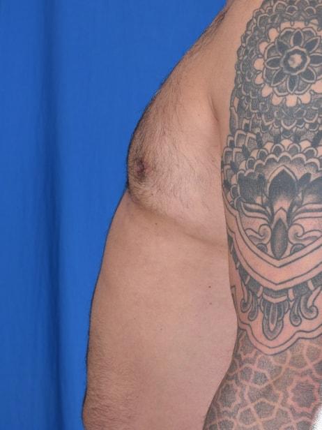 Gynecomastia Surgery after at Millard Plastic Surgery in Englewood, CO