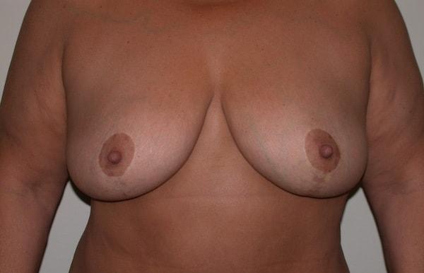 Breast Lift after at Millard Plastic Surgery in Englewood, CO
