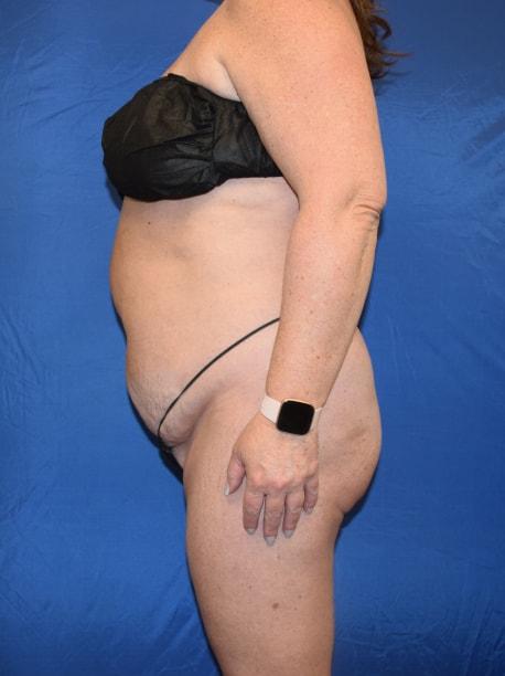 Mommy Makeover before at Millard Plastic Surgery in Englewood, CO