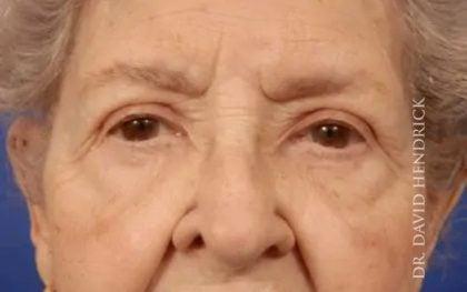 Blepharoplasty after at Millard Plastic Surgery in Englewood, CO