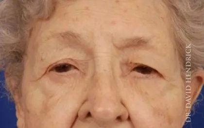 Blepharoplasty before at Millard Plastic Surgery in Englewood, CO