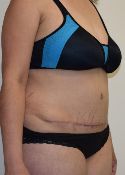 Mini Tummy Tuck after at Millard Plastic Surgery in Englewood, CO