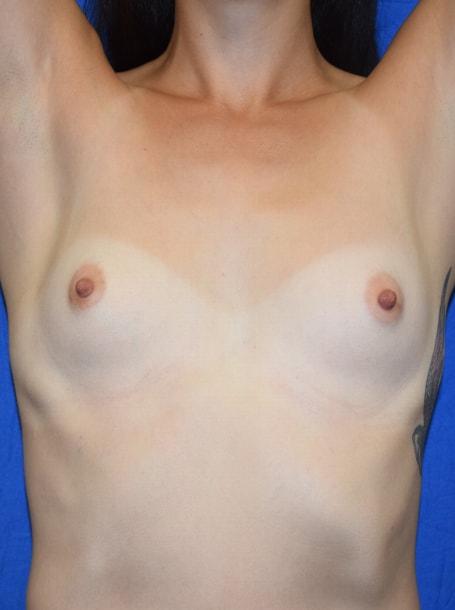 Breast Augmentation before at Millard Plastic Surgery in Englewood, CO