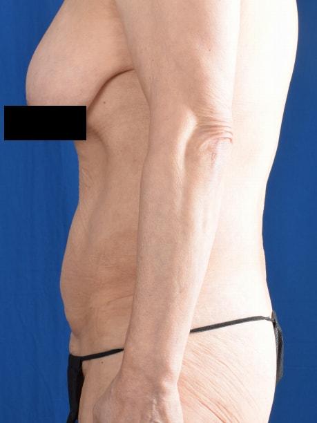 Mini Tummy Tuck before at Millard Plastic Surgery in Englewood, CO