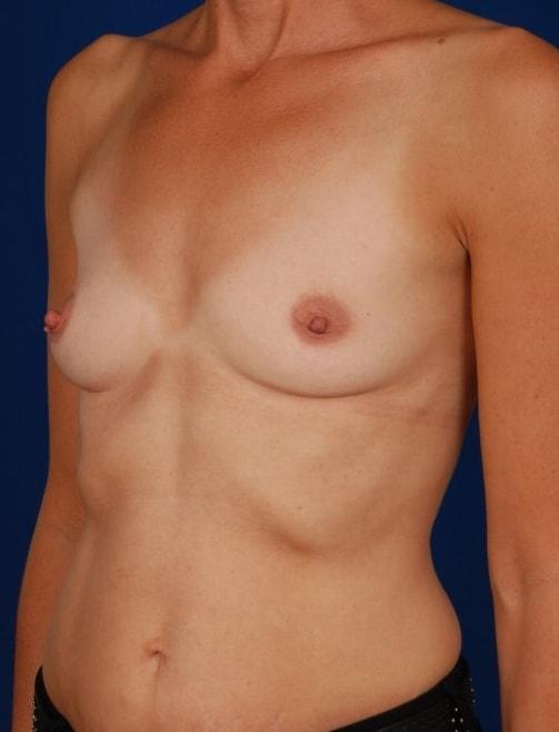 Breast Augmentation before at Millard Plastic Surgery in Englewood, CO