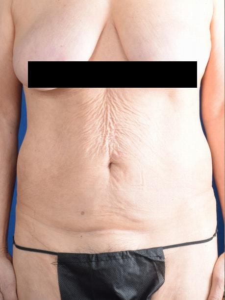 Mini Tummy Tuck before at Millard Plastic Surgery in Englewood, CO
