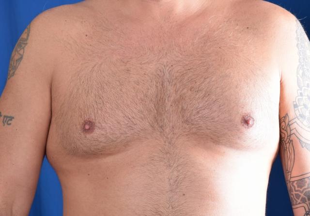 Gynecomastia Surgery before at Millard Plastic Surgery in Englewood, CO