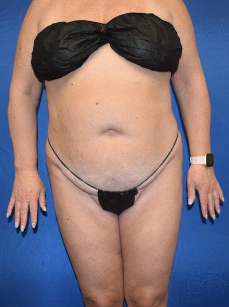 Mini Tummy Tuck before at Millard Plastic Surgery in Englewood, CO