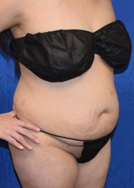 Mini Tummy Tuck before at Millard Plastic Surgery in Englewood, CO