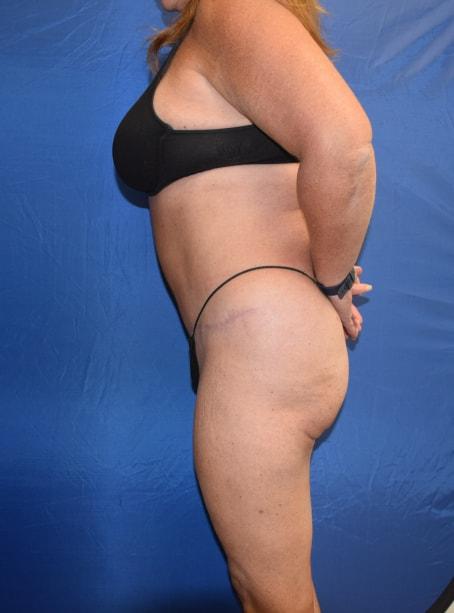 Mommy Makeover after at Millard Plastic Surgery in Englewood, CO
