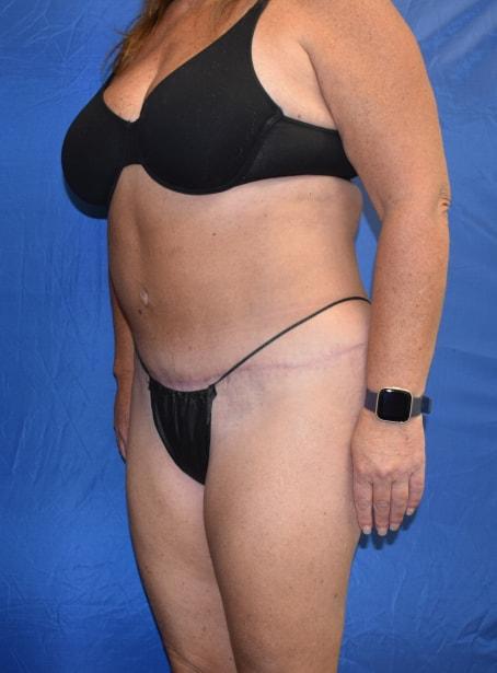 Mini Tummy Tuck after at Millard Plastic Surgery in Englewood, CO