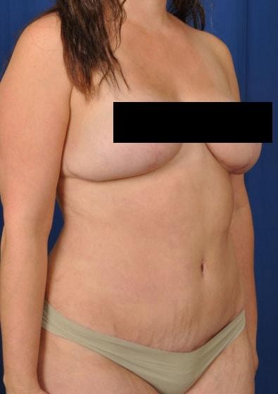 Mommy Makeover after at Millard Plastic Surgery in Englewood, CO