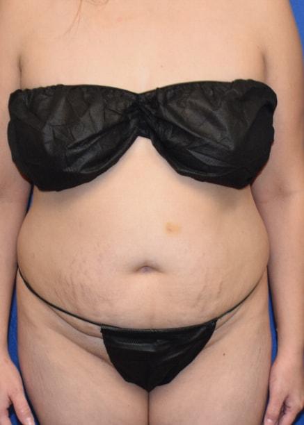 Mini Tummy Tuck before at Millard Plastic Surgery in Englewood, CO