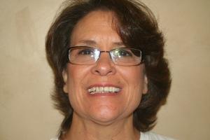 Dental Veneers before at Red Cliffs Dental in St. George, UT