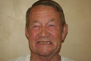 Smile Makeover before at Red Cliffs Dental in St. George, UT