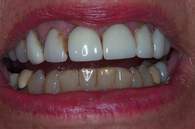 Dental Veneers before at Newport Beach Dental Solutions in Newport Beach, CA