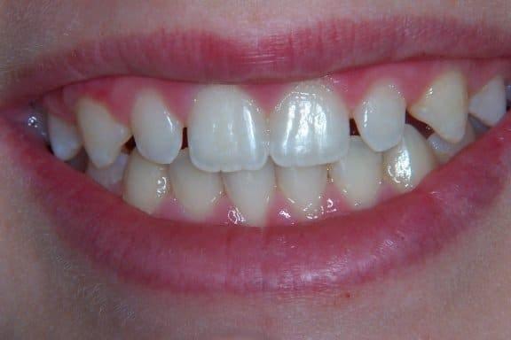 Dental Veneers before at Newport Beach Dental Solutions in Newport Beach, CA