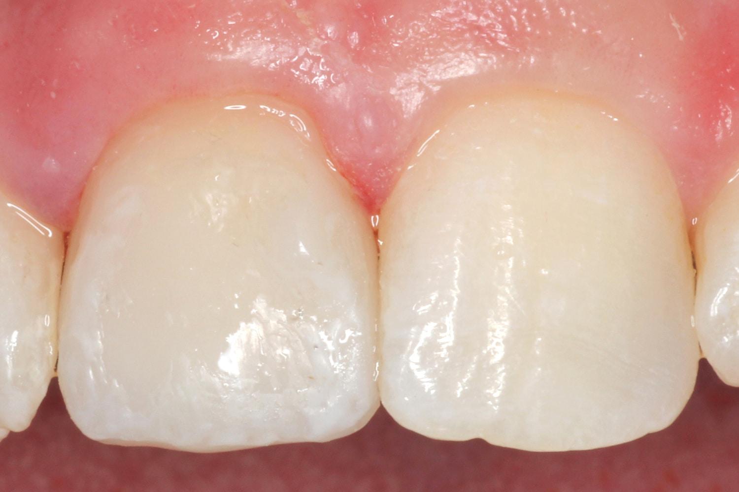 Newport Beach Dental Solutions veneers after — Newport Beach, CA