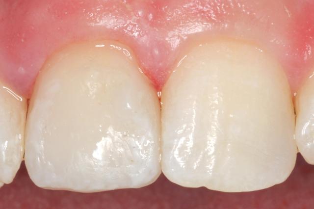 Dental Veneers after at Newport Beach Dental Solutions in Newport Beach, CA